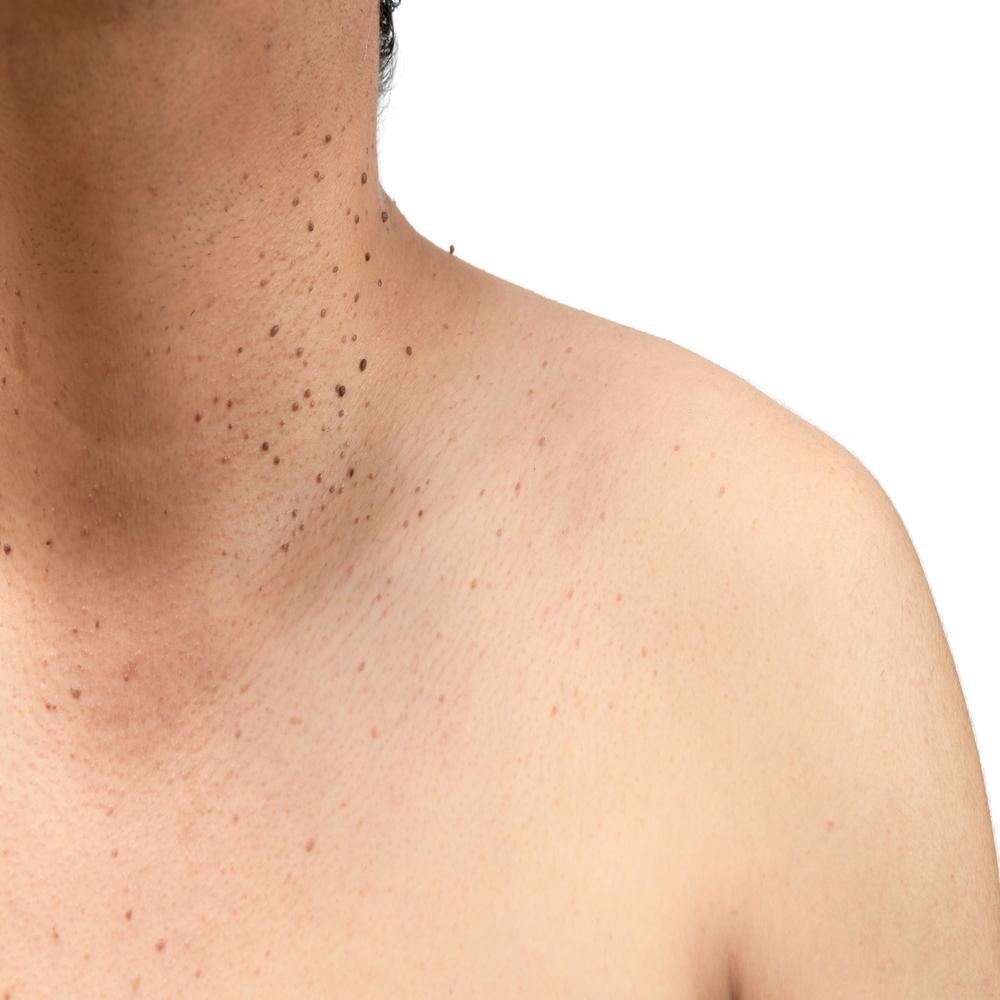 Body Treatment – Skin Tag Removal